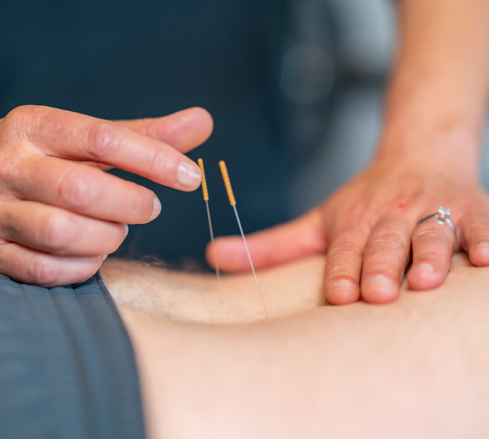 Manual Therapy Dry Needling